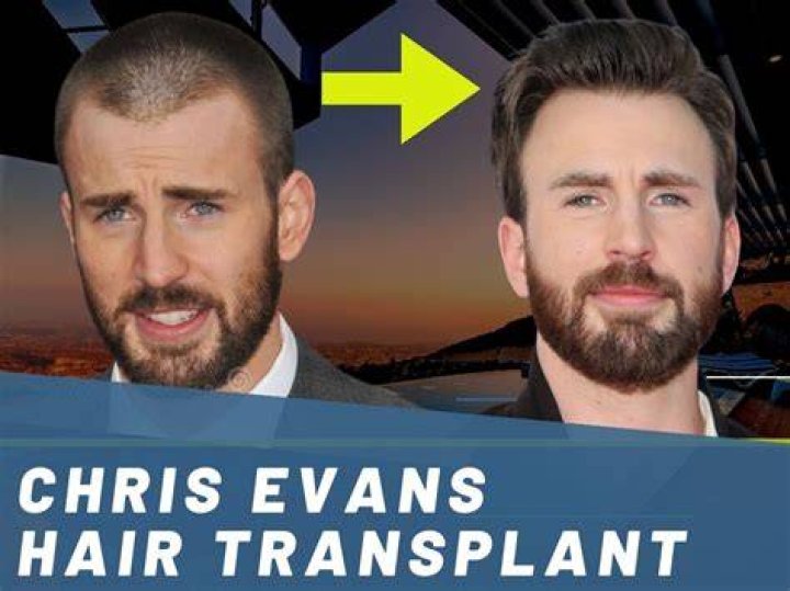 
Facial Hair Transformation And New Looks: Is Sam Rockwell Bald? 