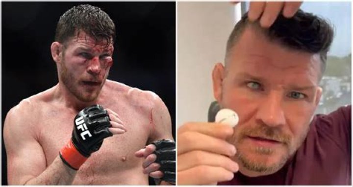 
What Happened To Michael Bisping’s Left Eye, Is He Permanently Blind? 